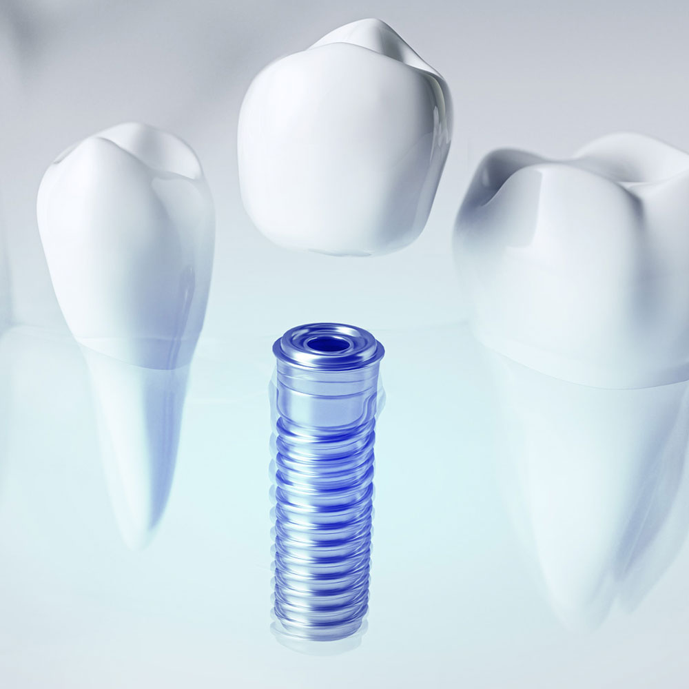 Diş implantları